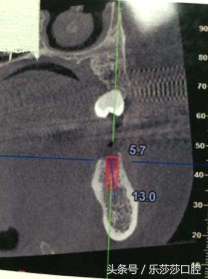 种植牙到底有多痛苦,种植牙真实经历详细全部过程