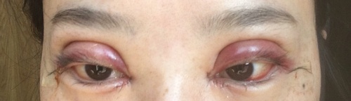 全切双眼皮疤痕增生多久可以恢复,全切双眼皮恢复过程经历真实