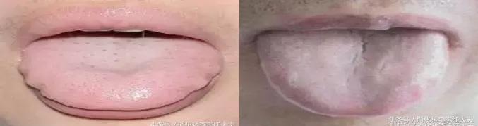 反流食管炎加萎缩性胃炎中医治疗,反流性食管炎中医把脉能看出来吗