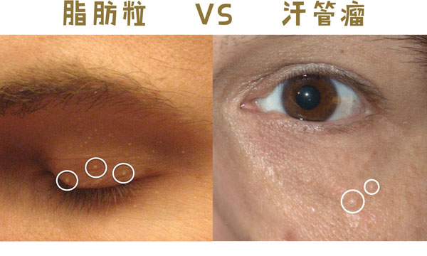 眼睛周围长满脂肪粒是怎么回事,眼睛周围长满了脂肪粒是怎么回事