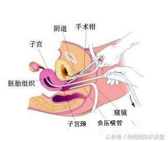 孕妇怀孕28周该注意什么,怀孕28周什么情况才能引产