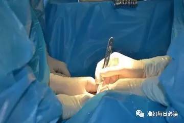 剖宫产的医学指征，出现这些状况，准妈只能剖腹产了！