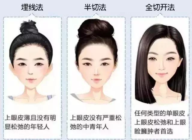 原来双眼皮有必要继续割吗,双眼皮割得还是很成功的