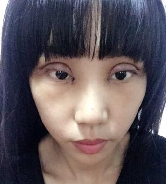 双眼皮割得太宽了怎么办,眼骨低割不了太宽的双眼皮