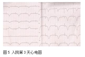 心前区疼痛、憋闷、咽部有紧缩感，伴出汗、呕吐可能是什么病？