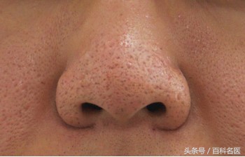 毛孔粗大黑头多脸爱出油怎么解决,毛孔粗大黑头多有闭口脸色暗沉