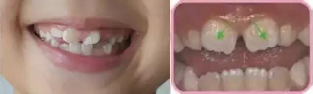 小孩开始换牙了,宝爸宝妈看过来你家宝贝换牙了吗