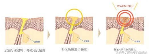 烫伤后毛孔变大会恢复正常吗,清洁毛孔后不收缩毛孔会变大吗