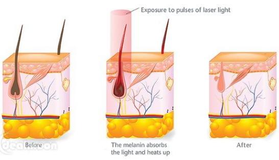 激光脱毛有什么弊端,为什么激光脱毛效果不好