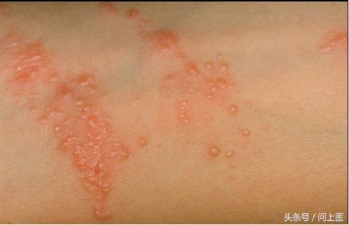 图解成年人常见的皮肤问题