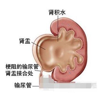 胎儿肾积水是什么原因引起的,胎儿肾积水越来越多怎么办