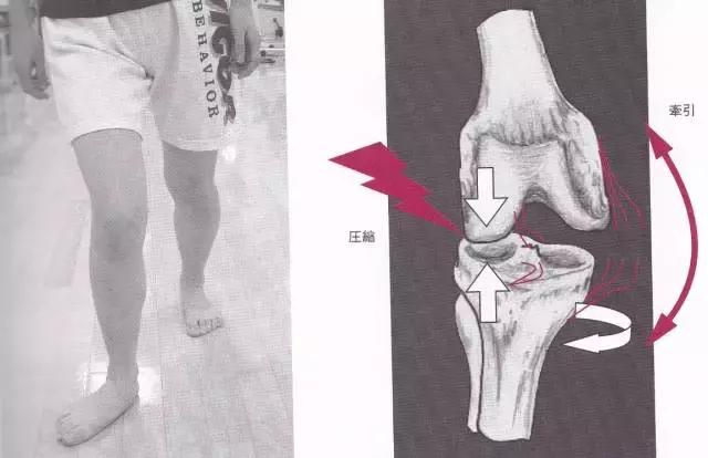 八字脚对跑步有影响吗,跑步时八字脚产生原因及纠正方法