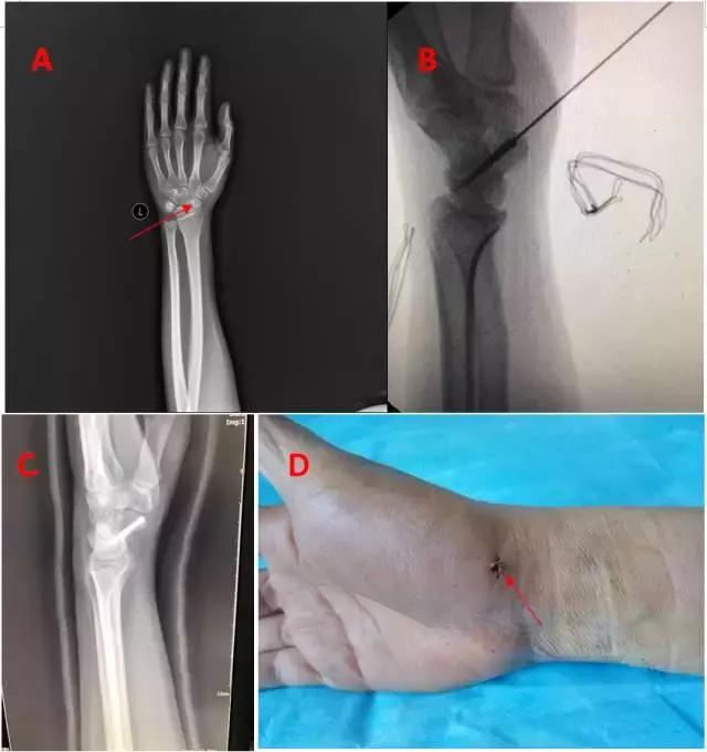 腕舟骨骨折最佳治疗方法,关节镜下治疗舟骨骨折