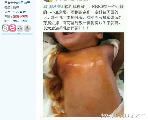 新生儿要挤乳核吗,新生儿乳核要挤吗