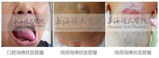 治疗血管瘤的最好医生,郭先锋谈血管瘤饮食禁忌