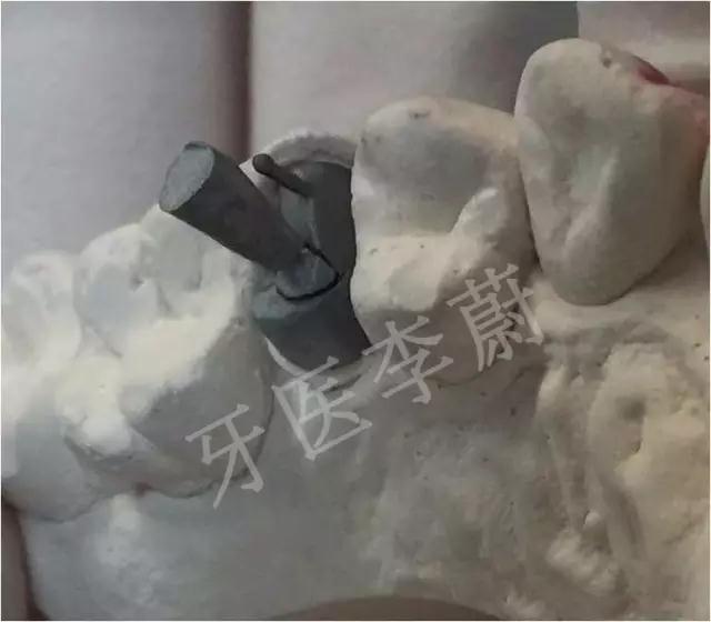 前牙残根桩冠修复,前磨牙嵌体修复