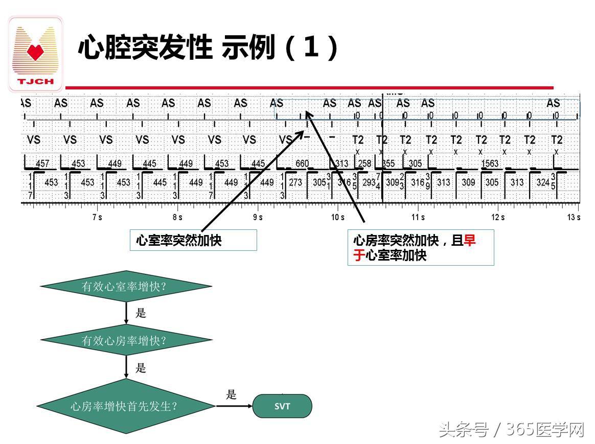 许静：新技术避免ICD不恰当放电