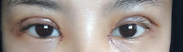 全切双眼皮15天,恢复的差不多了