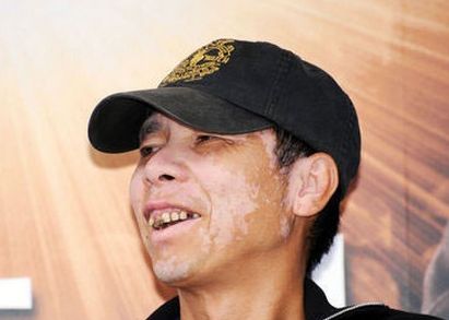 有什么方法快速治好白癜风,大家看白癜风都用哪些药