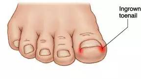 嵌甲自己剪出来就好了吗,嵌甲能修脚吗