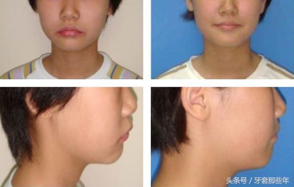 戴牙套矫正要打骨钉吗,矫正先拔牙还是先戴牙套