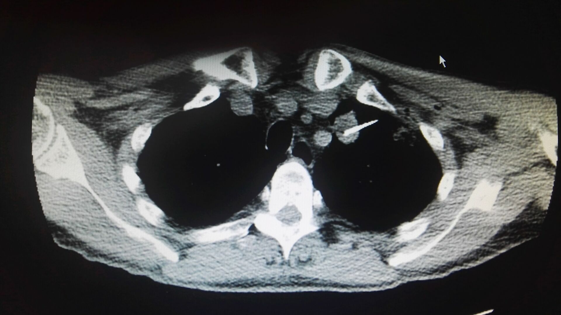 南通肺结节微创手术费用,合肥治肺癌的消融术
