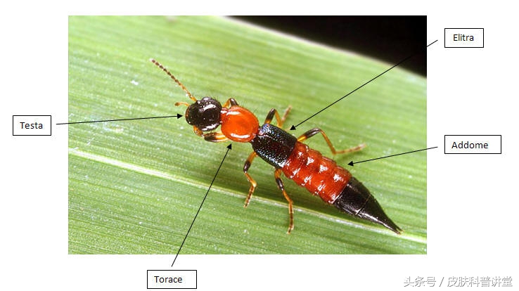隐翅虫皮炎部位睡觉需要避开吗,晚上睡觉怎么避免隐翅虫