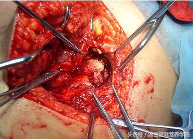 如何医治骨刺最有效,治骨刺偏方视频