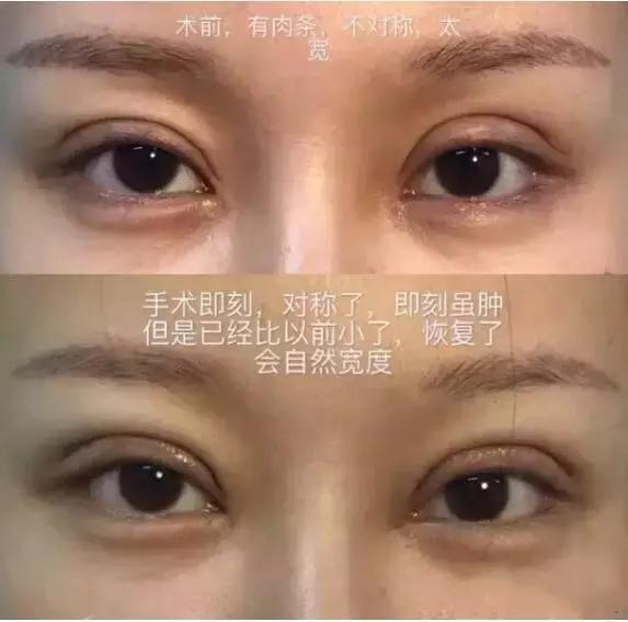 割一个双眼皮去哪做修复,修复3000块的双眼皮你敢做吗