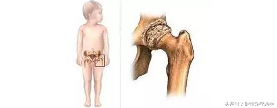 儿童股骨头坏死最佳治疗方案,诊断股骨头坏死是ct还是核磁共振