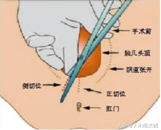 顺产也要挨一刀,顺产侧切一刀缝几针