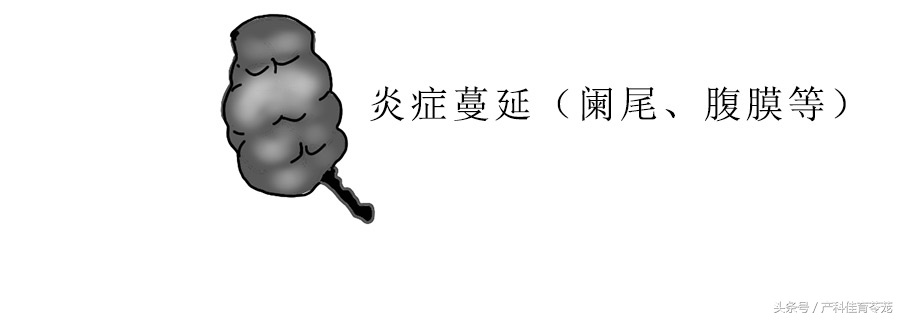 治疗盆腔炎最好最快是用什么药,盆腔炎能不能彻底治好