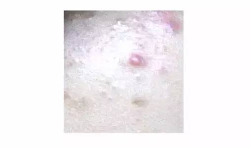 黑头粉刺满是痘痘,粉刺和痘痘肌的区别