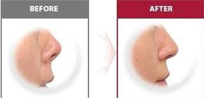 鼻部整形有哪些注意事项,鼻部整形一个月内能做剧烈运动吗