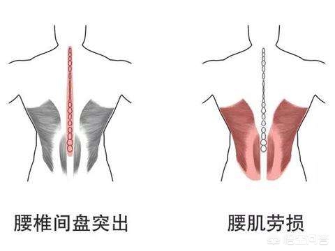 腰肌劳损是腰部力量不够吗,腰肌劳损是不是就废了