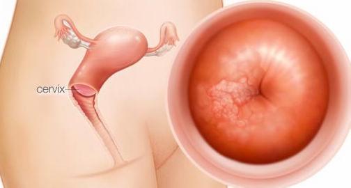 宫颈癌复发多处转移放疗能治愈吗,宫颈癌放化疗治愈后能复发吗