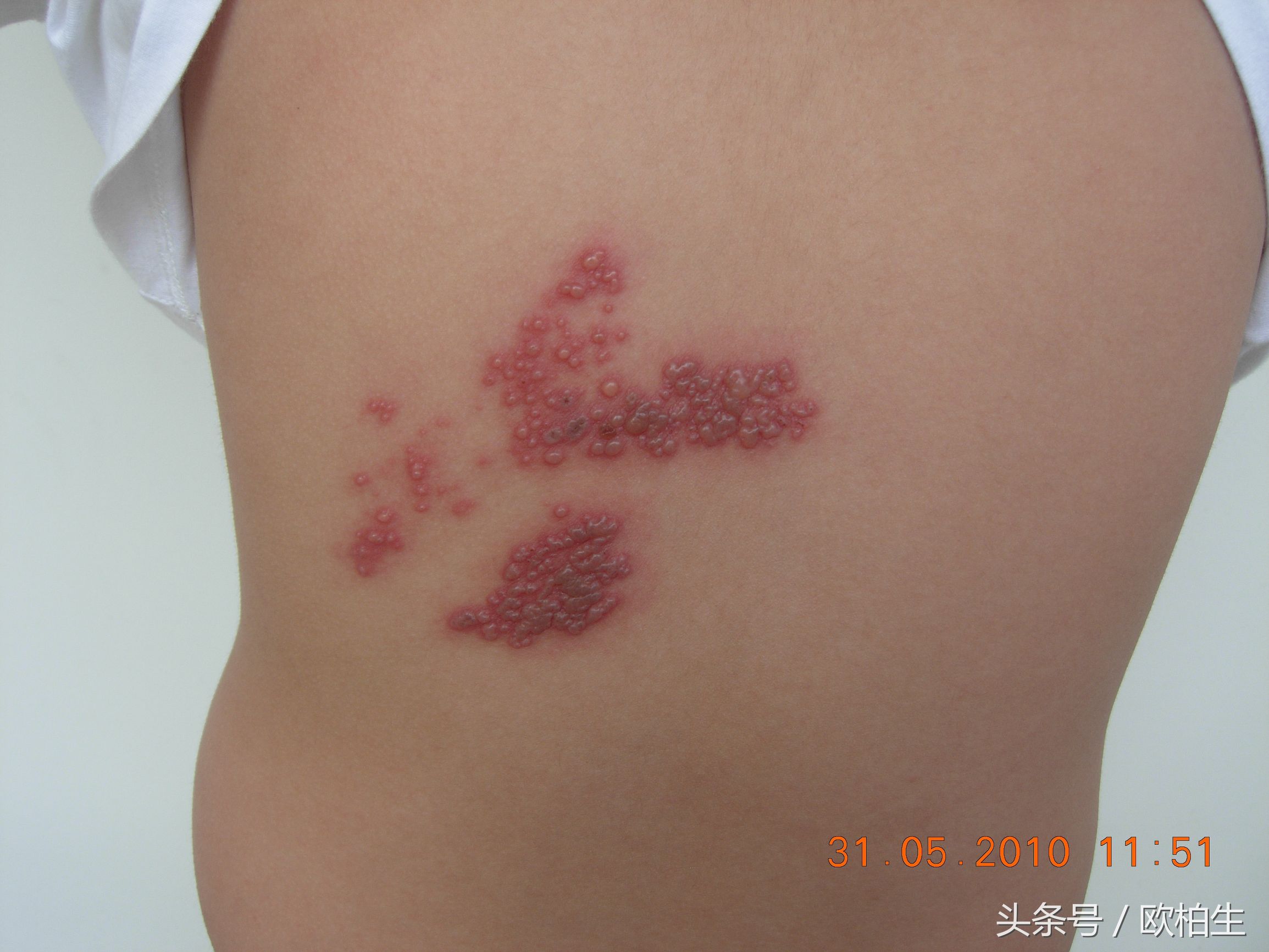 治带状疱疹中医名方,经方治疗带状疱疹