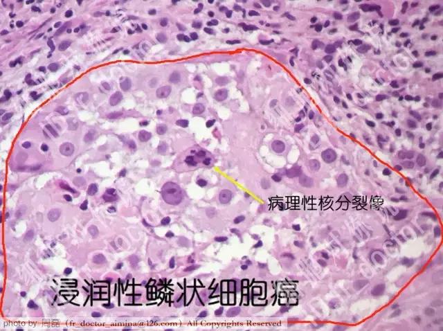 宫颈高度病变镜下观察,宫颈镜下可疑浸润癌严重吗