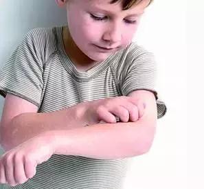 过敏荨麻疹是怎么来的,过敏性荨麻疹如何得的