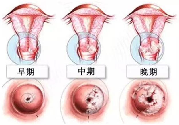 宫外孕大出血是怎么回事,宫外孕大出血前会有征兆吗