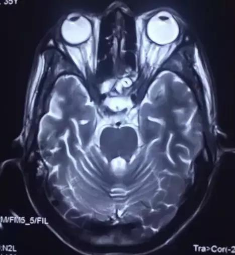 奇迹！跨越600公里疾速异地协作百草枯中毒患者起死回生