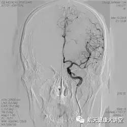 脑卒中的防治健康讲座,急性脑卒中科普知识
