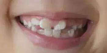小孩子换的牙齿为什么越来越丑,小孩换的新牙又掉了怎么办