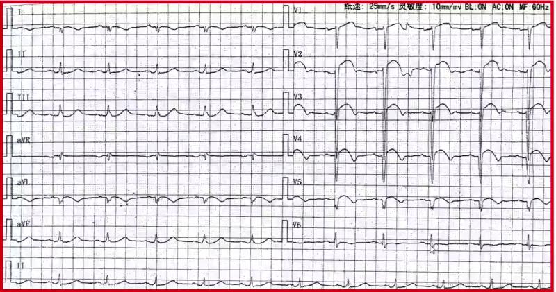冠状动脉粥样硬化性心脏病知识点,冠状动脉粥样硬化性心脏病怎样治
