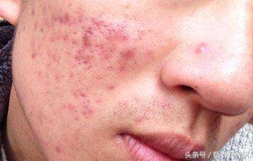 如何去除痘印和黑头,如何祛除痘印学生党