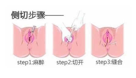 如何护理顺产侧切伤口,夏季顺产侧切怎么护理伤口