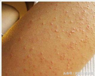 果酸焕肤精华液与果酸的区别,果酸换肤适合角质层薄的人吗