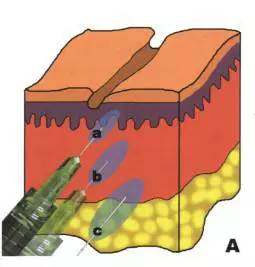 井柏然撞脸金城武，“僵硬”神器玻尿酸这次反而救了人？