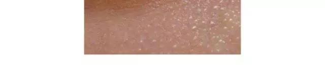 去眼部脂肪粒最有效的方法,怎么去脸上脂肪粒最快的简单方法