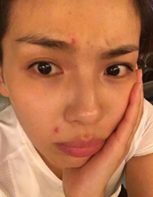 长痘憋怕有涛姐陪着你呐